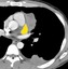 Axial contrast enhanced CT at the level of <strong>left ventricular appendage</strong> demonstrates a 5cm anterior mediastinal mass. The mass enhances heterogeneously, abuts and is inseprable from the left ventricular appendage, with no fat plane separating between them. There is a pleural nodule associated with a tiny effusion. There is no lymphadenopathy. Because of the pleural nodule, this is most suggestive of a stage IVa thymoma, which was confirmed at surgery. However, despite the tumor abutting the left atrial appendage, no pericardial invasion was seen at surgery.